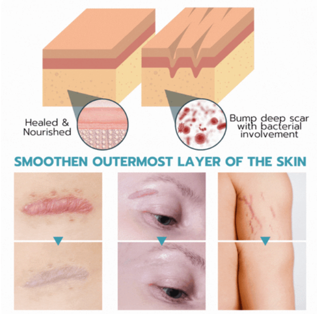 GlowCabinent™ Silicone Scar Sheets